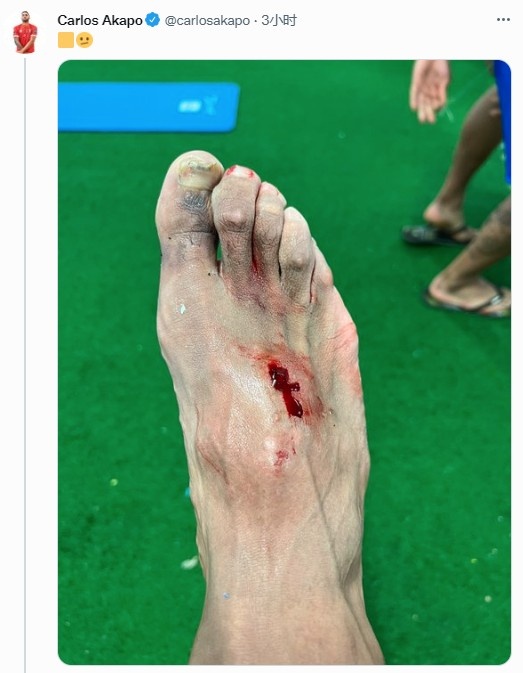 加的斯球员遭阿扎尔踩到脚面，赛后晒伤口照